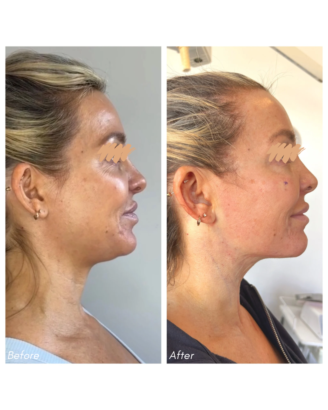 Facial Harmony Before and After