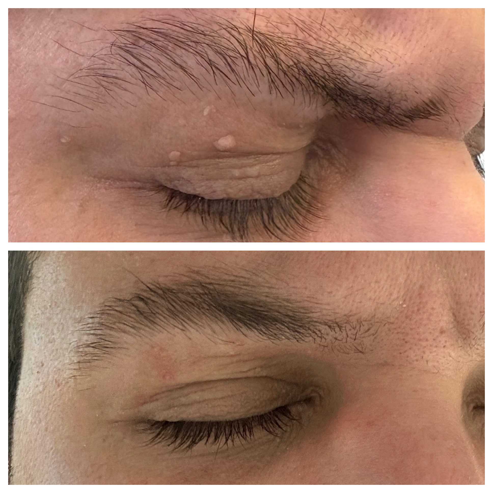 Skin Lesion Removal Before and After