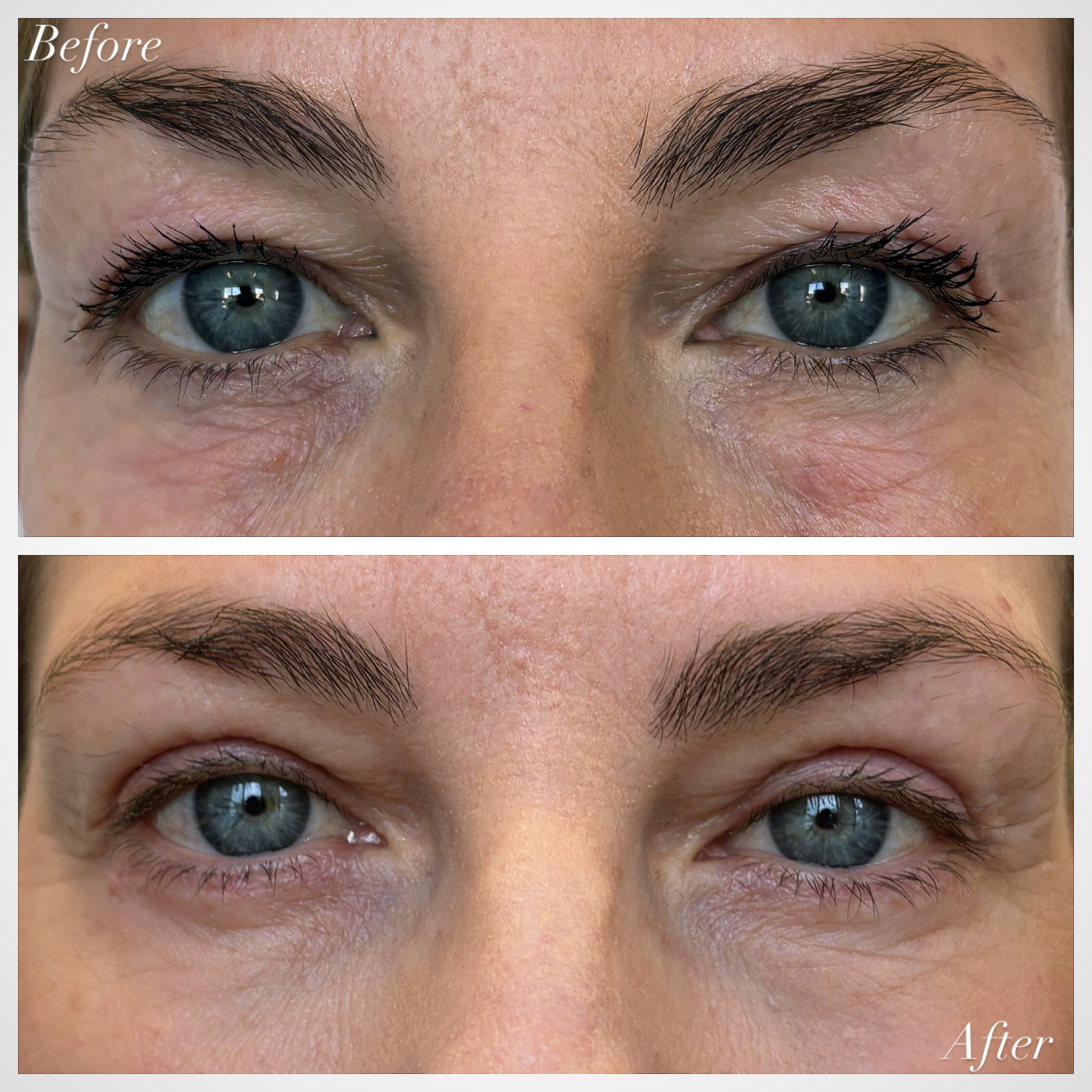 Upper Blepharoplasty Before and After