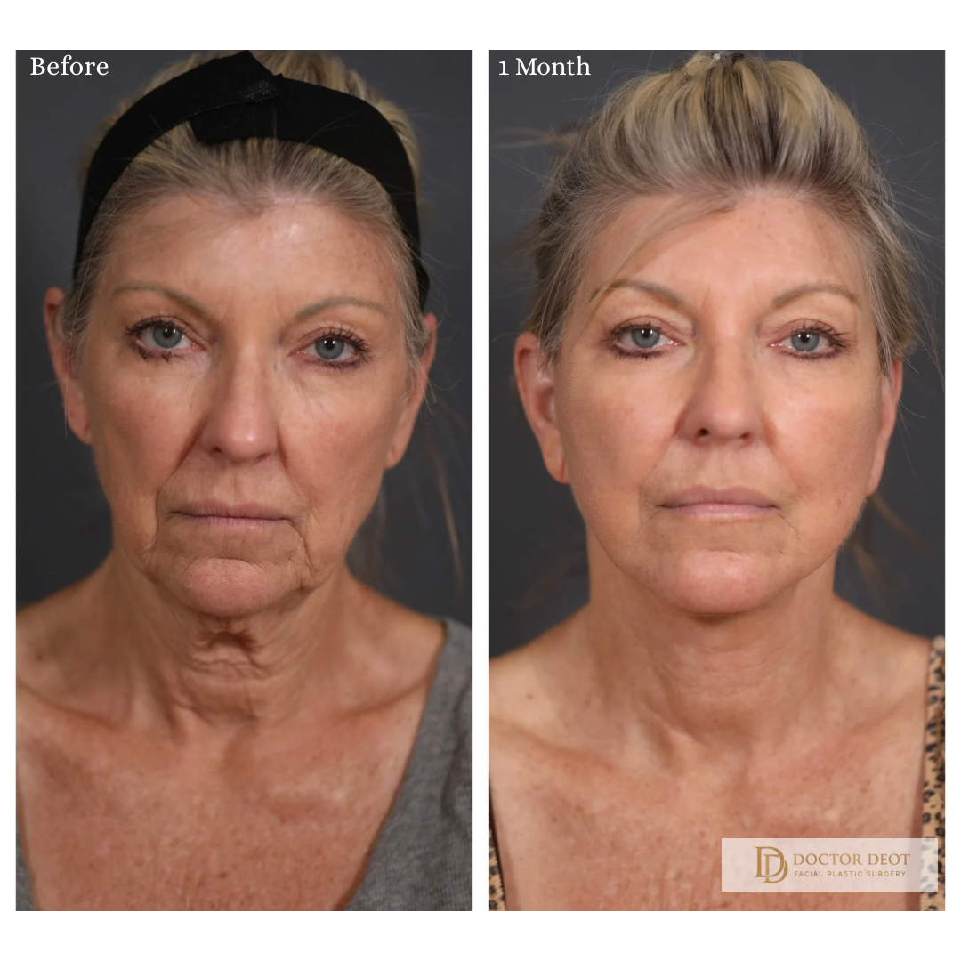 Profile Refinement Before and After