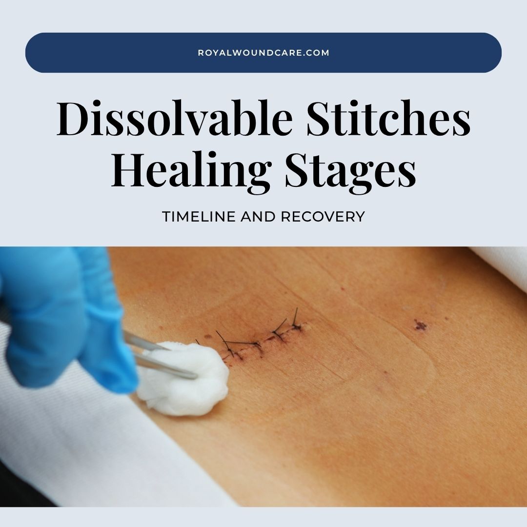 Dissolvable Stitches Healing Stages: Timeline and Recovery