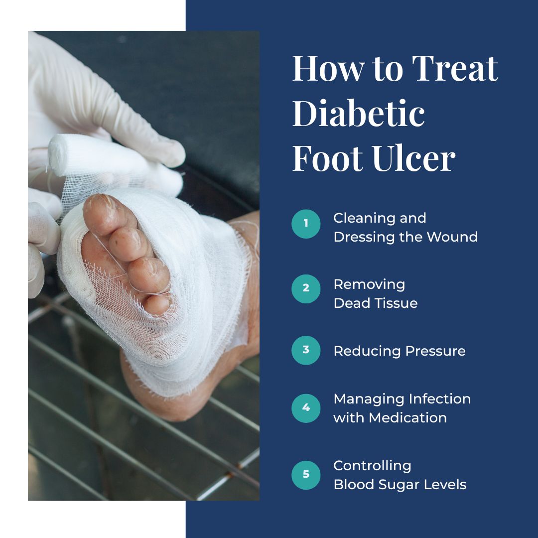 How to Treat Diabetic Foot Ulcer