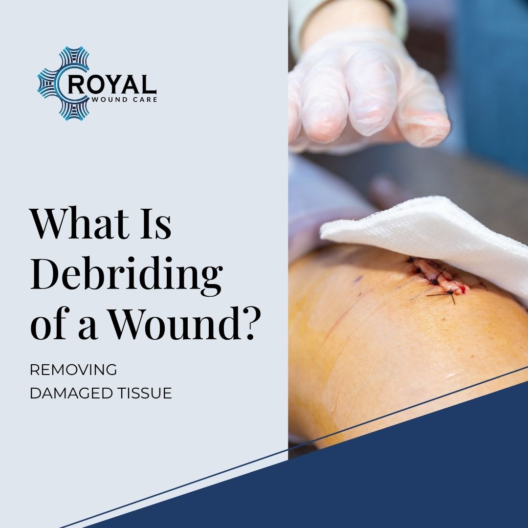 What Is Debriding of a Wound