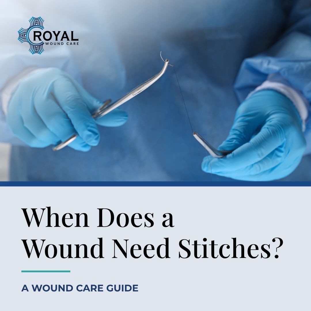When Does a Wound Need Stitches? A Wound Care Guide