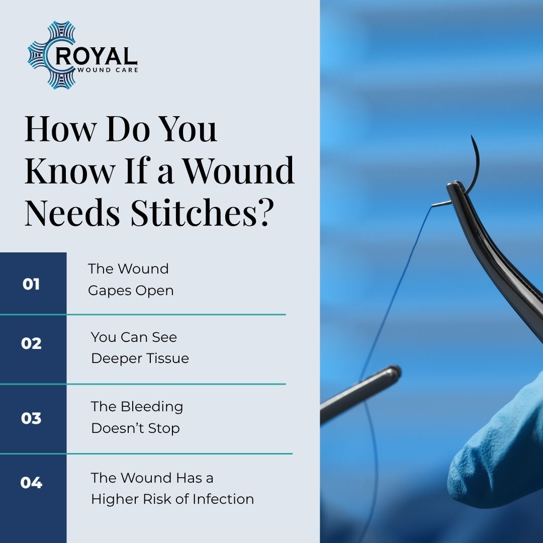 How Do You Know If a Wound Needs Stitches
