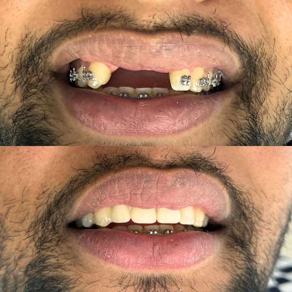 Caso real: antes y después de rehabilitación dental