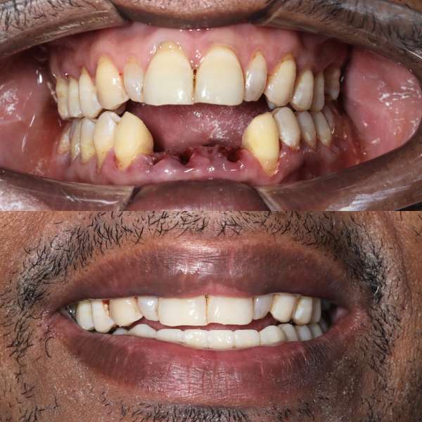 Caso real: antes y después de implante dental