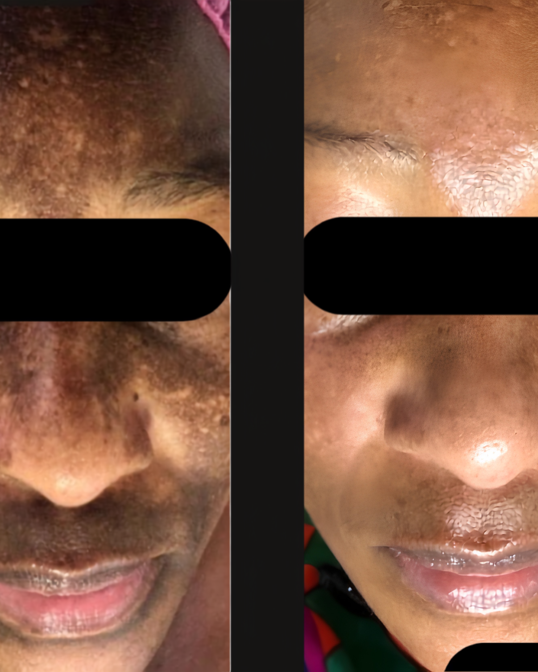 HydraFacial Glow Protocol