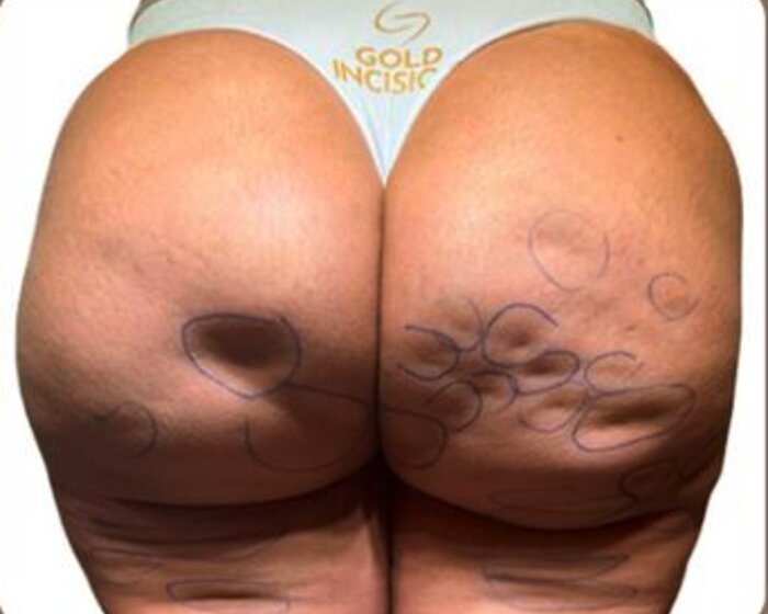 Antes — caso real Gold Incision®