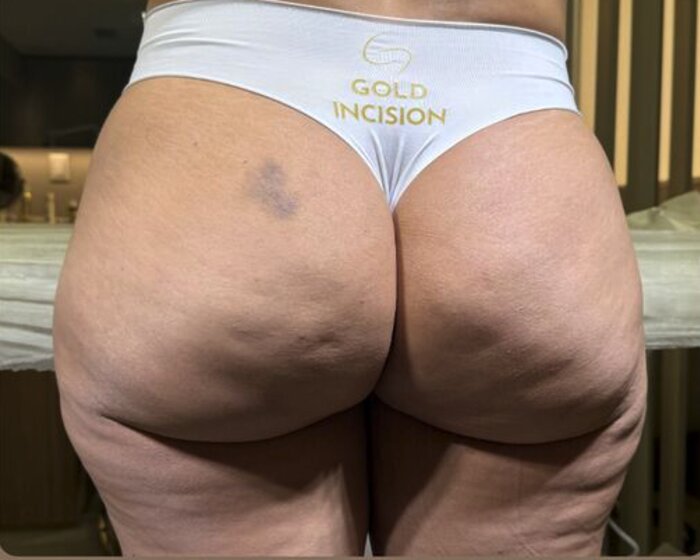 Antes — caso real Gold Incision®