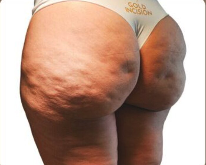 Antes — caso real Gold Incision®