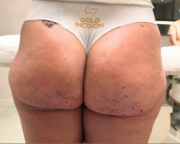Después — caso real Gold Incision®