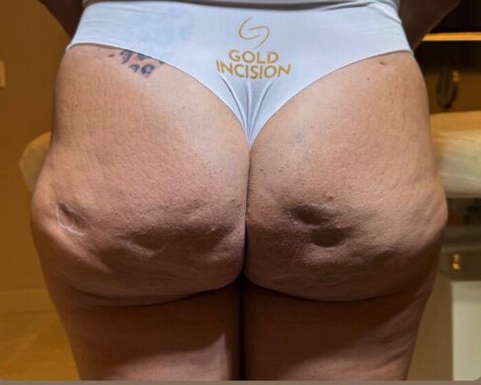 Antes — caso real Gold Incision®