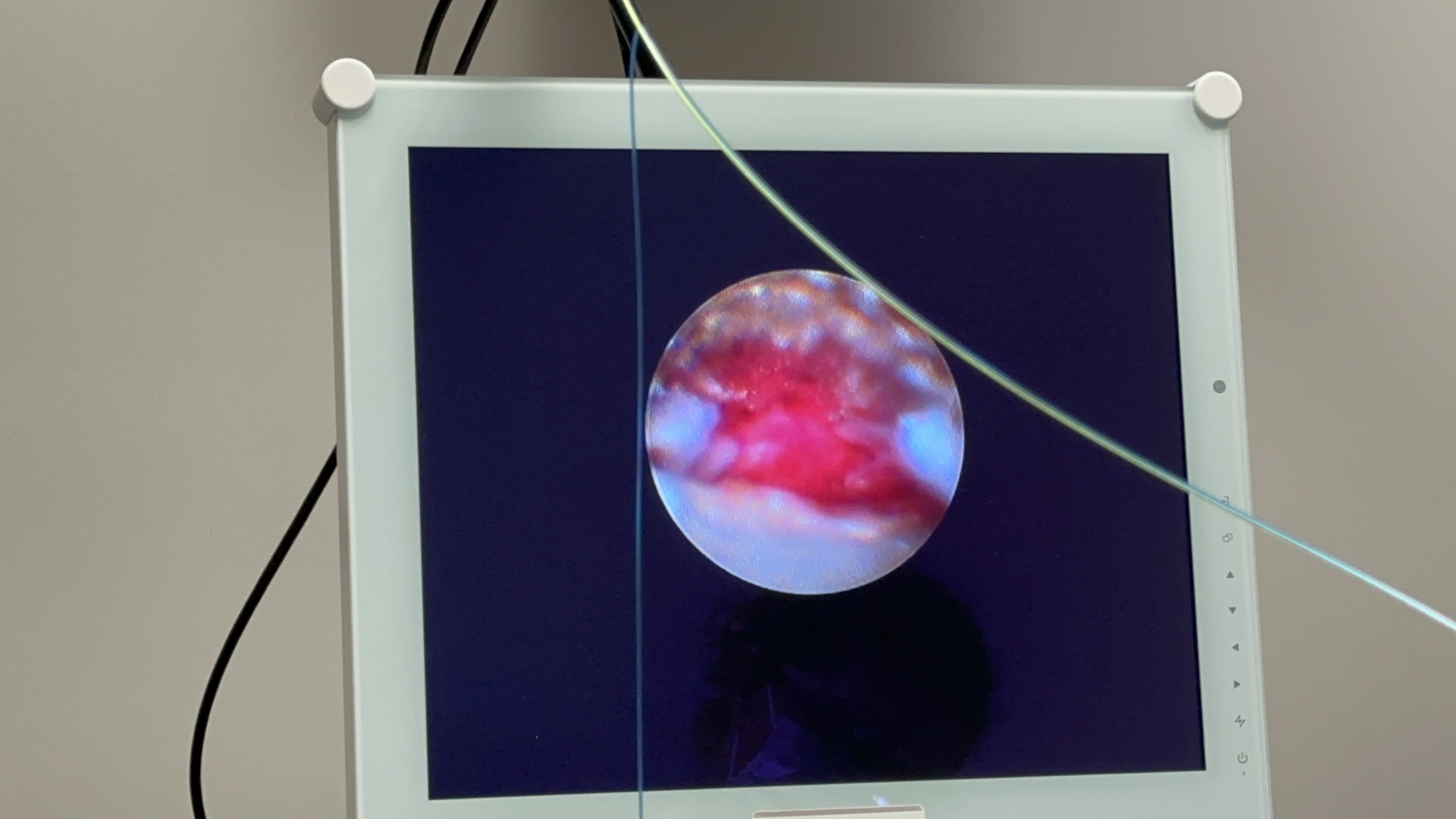 Subgingival tissue as displayed on the perioscopy monitor during treatment