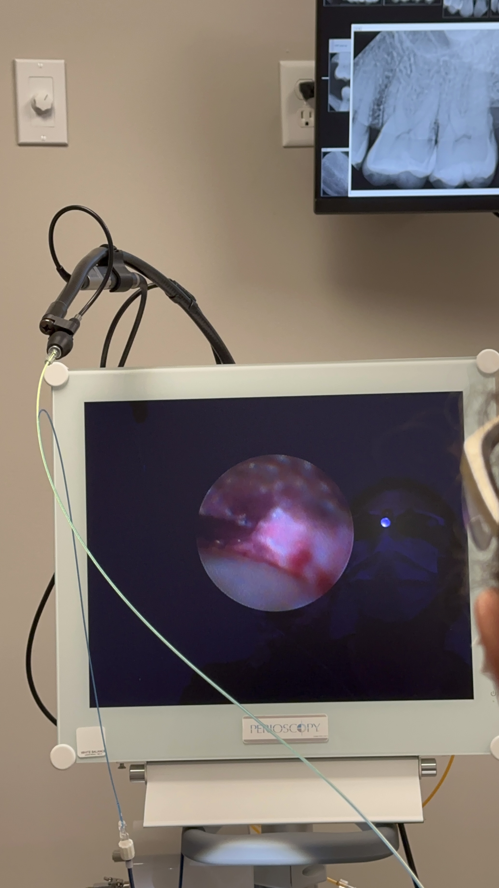 Subgingival root surface displayed on the perioscopy monitor during treatment