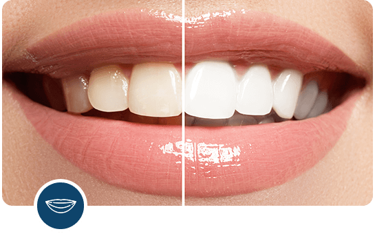 Radiant Teeth Whitening