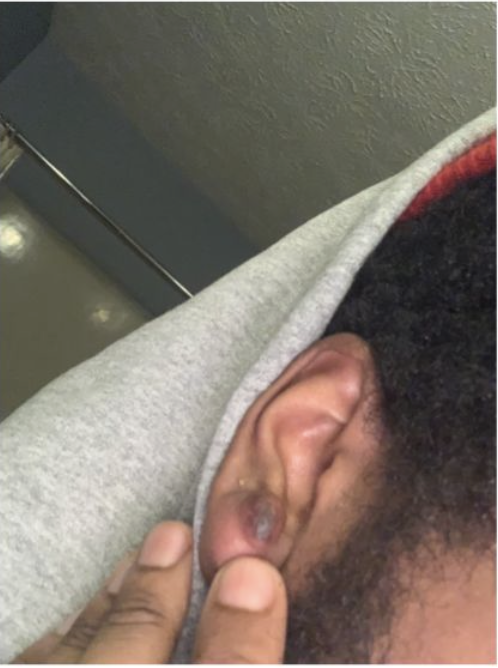 Jason's keloid before using Scalar Plasma Projector