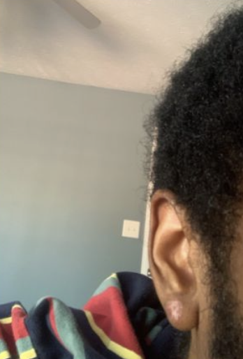 Jason's ear after 8 months using Scalar Plasma Projector