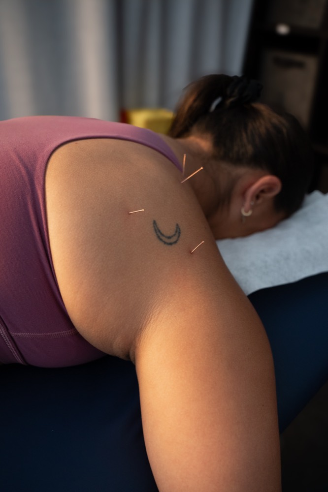 Dry needling applied to a client's shoulder
