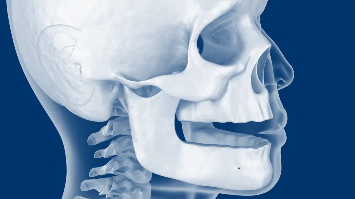 GIF/animacja pokazująca proces zaniku kości po utracie zęba