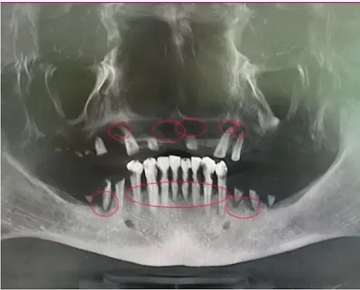Zdjęcie CBCT/tomografii szczęki z widocznymi ciemnymi obszarami infekcji w kości