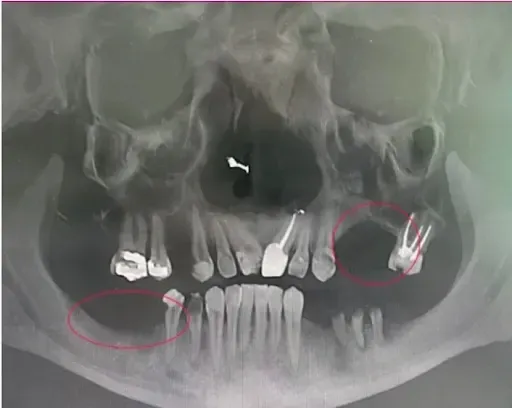 Drugi skan tomografii z dramatyczną różnicą - osoba, która zwlekała za długo