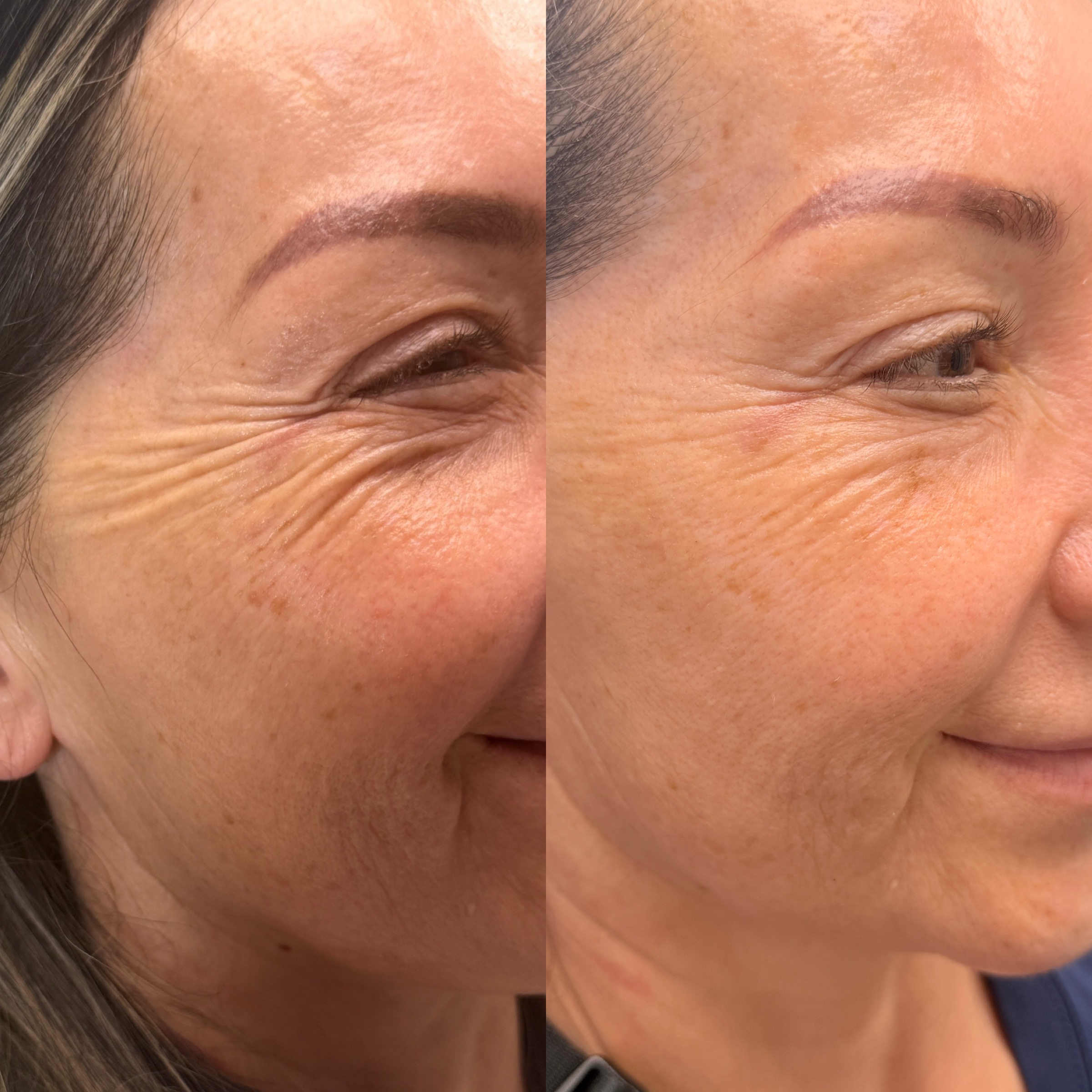 Wrinkle Relaxers before and after, GlowHaus Skin & Wellness, Allen TX