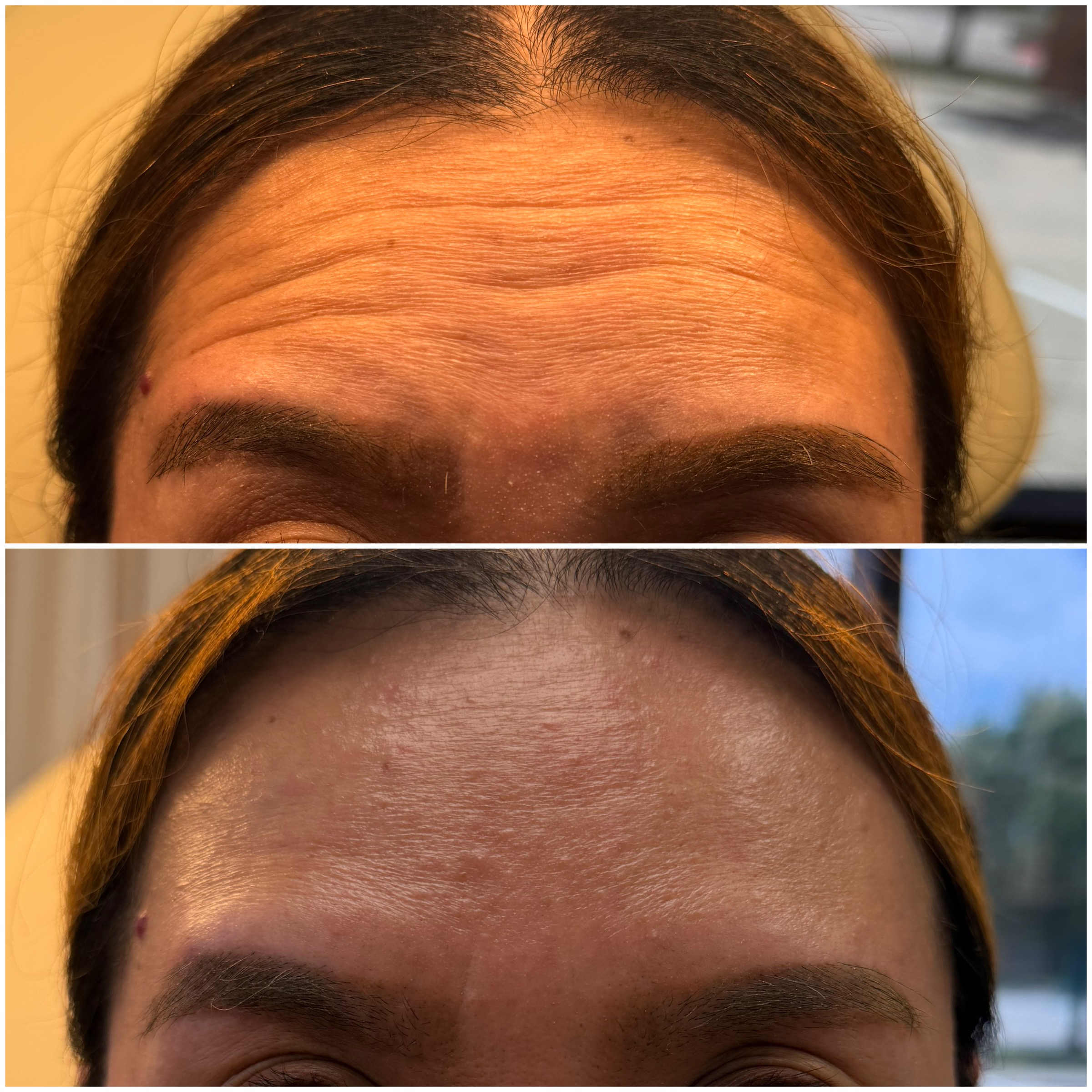 Wrinkle Relaxers before and after, GlowHaus Skin & Wellness, Allen TX