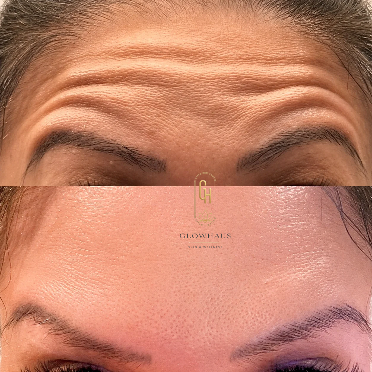 Wrinkle Relaxers before and after, GlowHaus Skin & Wellness, Allen TX