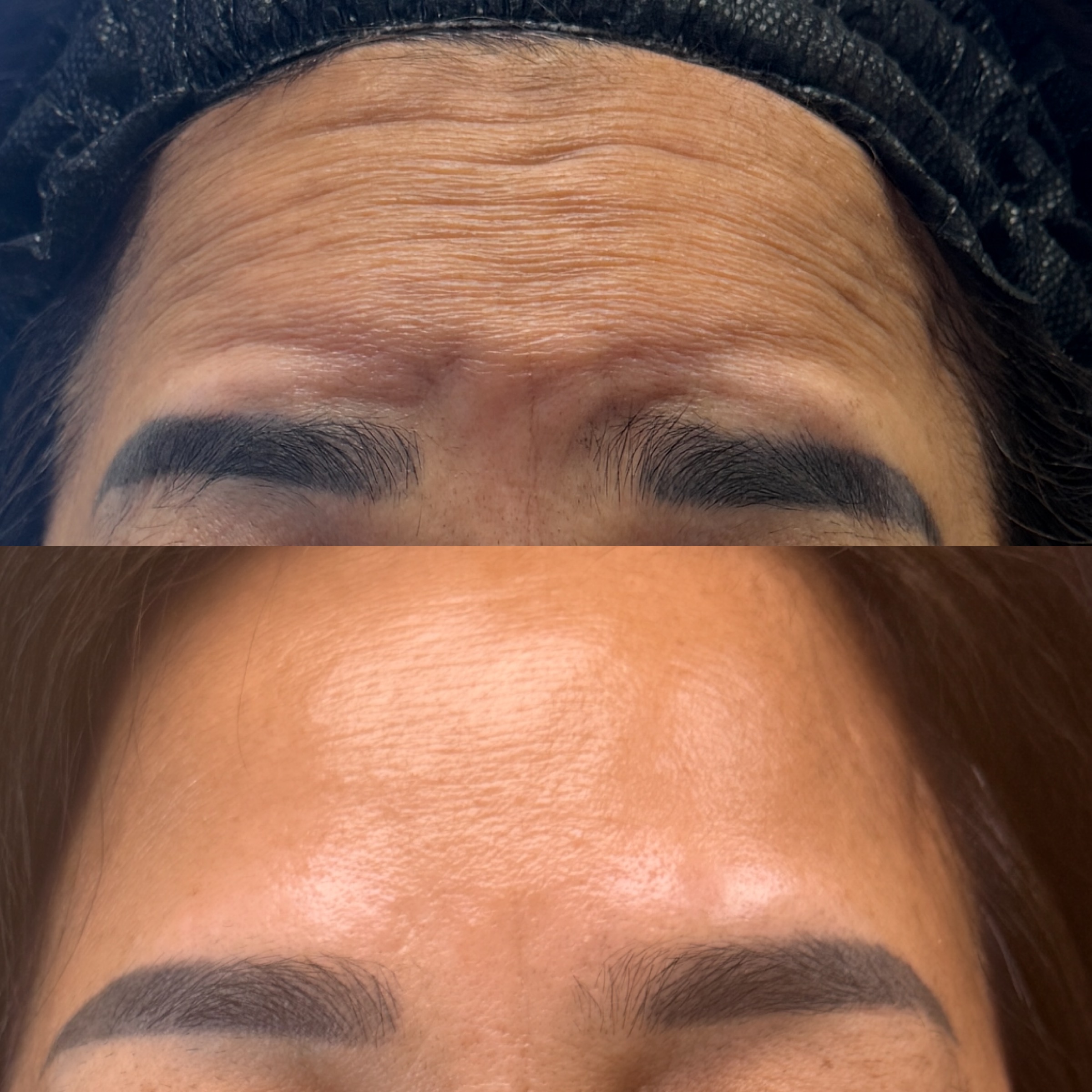 Wrinkle Relaxers before and after, GlowHaus Skin & Wellness, Allen TX