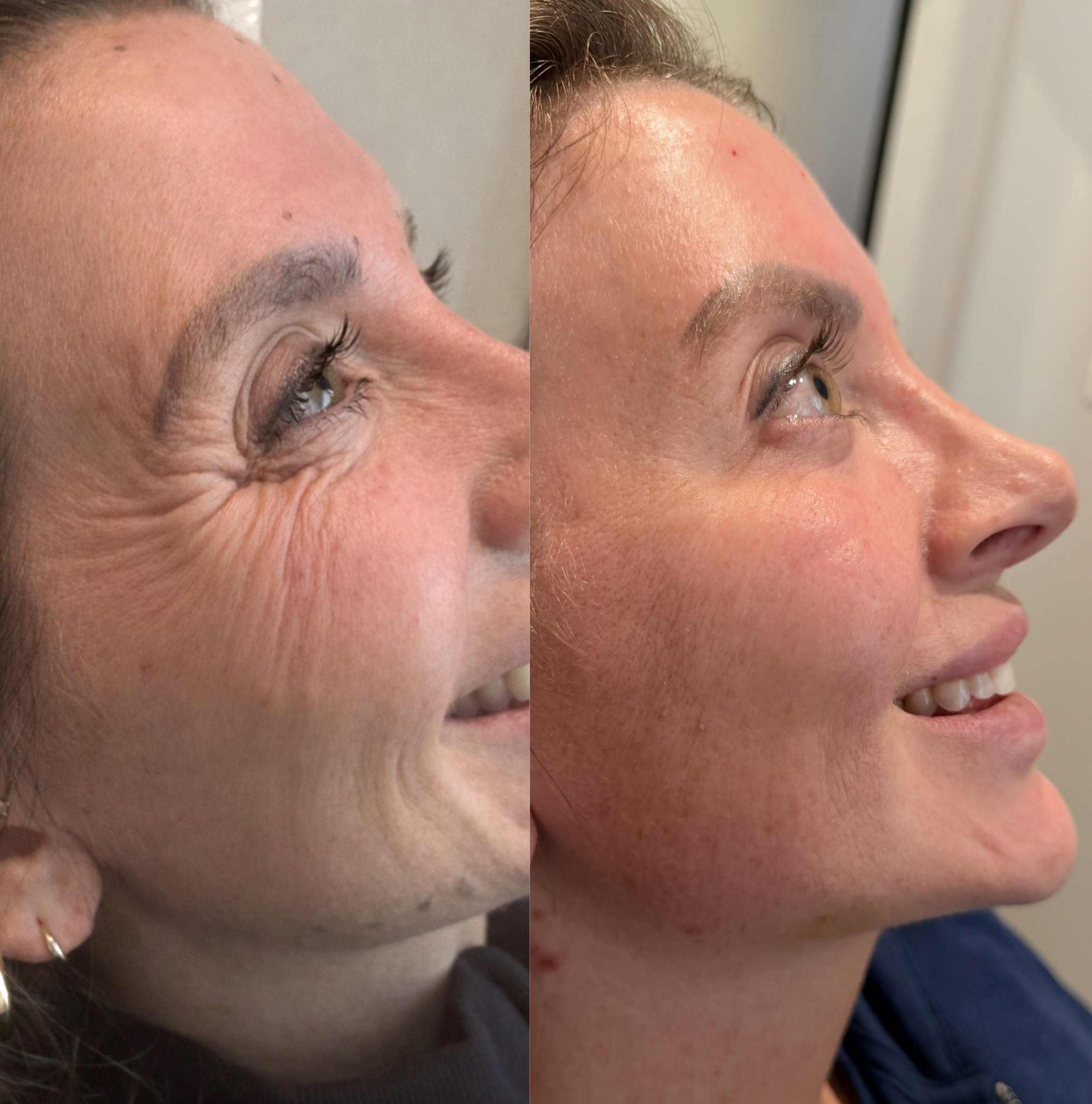 Wrinkle Relaxers before and after, GlowHaus Skin & Wellness, Allen TX