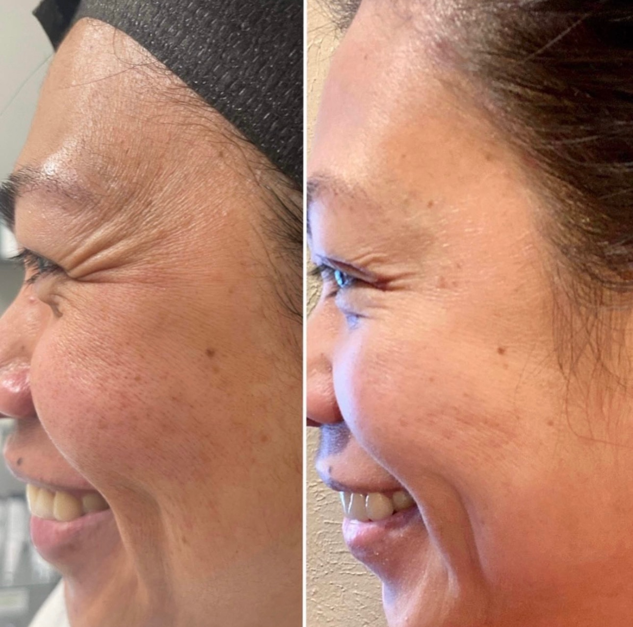 Wrinkle Relaxers before and after, GlowHaus Skin & Wellness, Allen TX