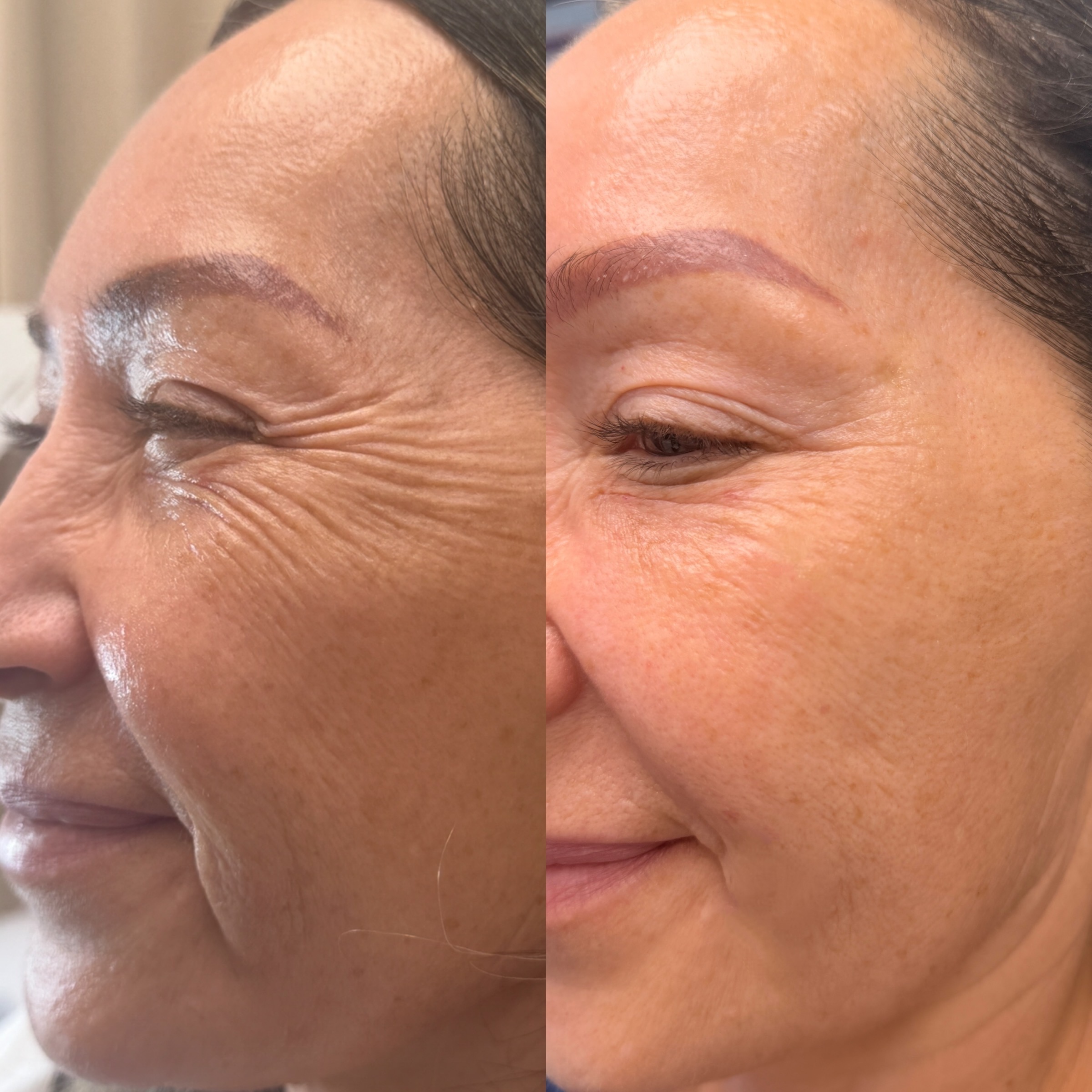 Wrinkle Relaxers before and after, GlowHaus Skin & Wellness, Allen TX