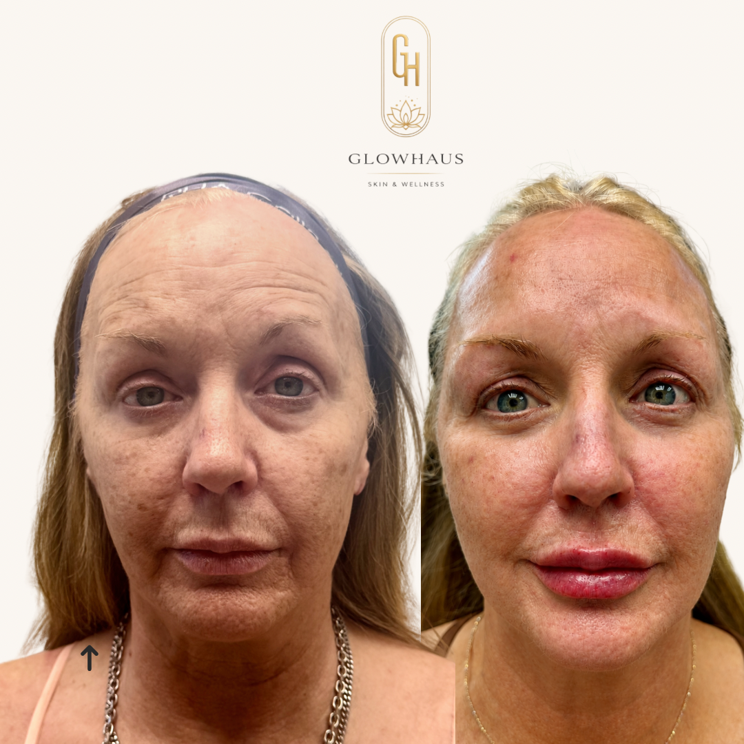 Sculptra before and after, GlowHaus Skin & Wellness, Allen TX