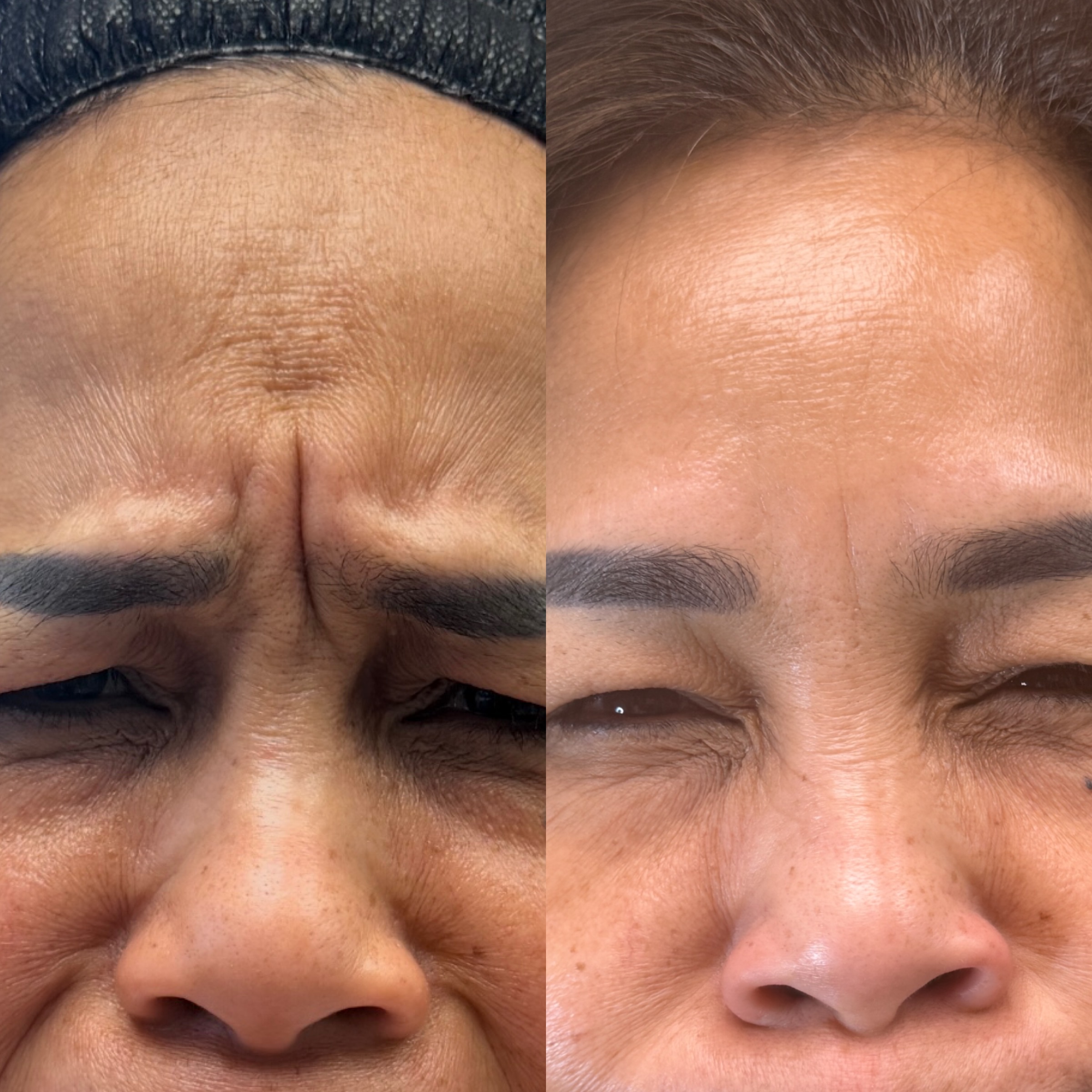 Wrinkle Relaxers before and after, GlowHaus Skin & Wellness, Allen TX