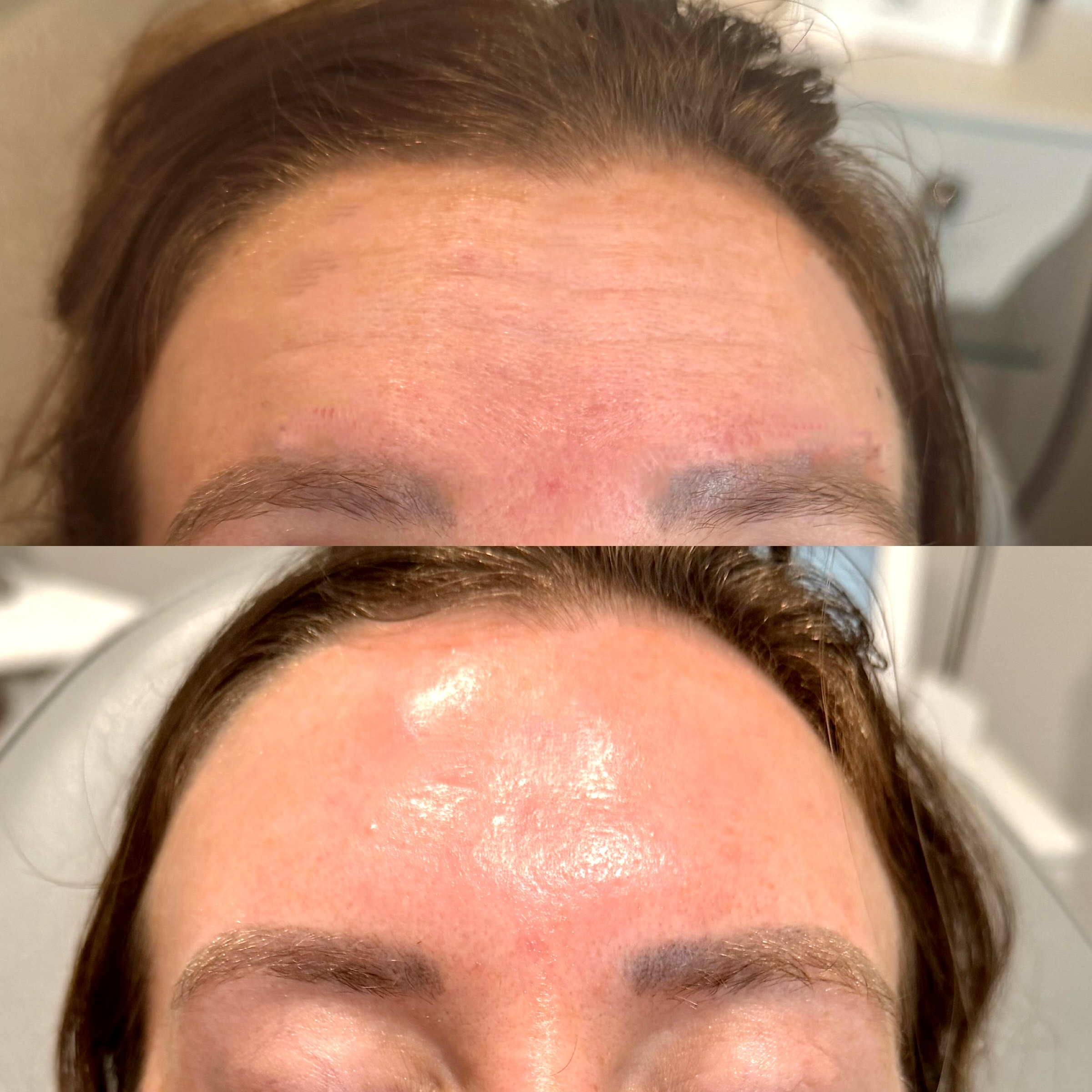 Wrinkle Relaxers before and after, GlowHaus Skin & Wellness, Allen TX