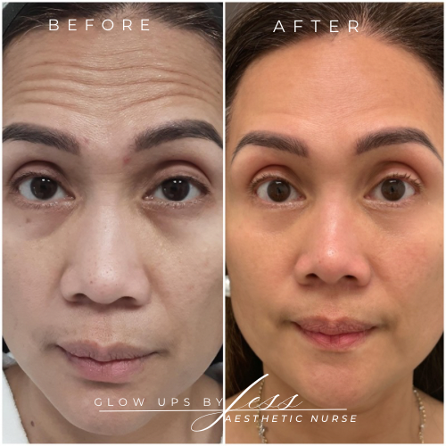 Wrinkle Relaxers before and after, GlowHaus Skin & Wellness, Allen TX