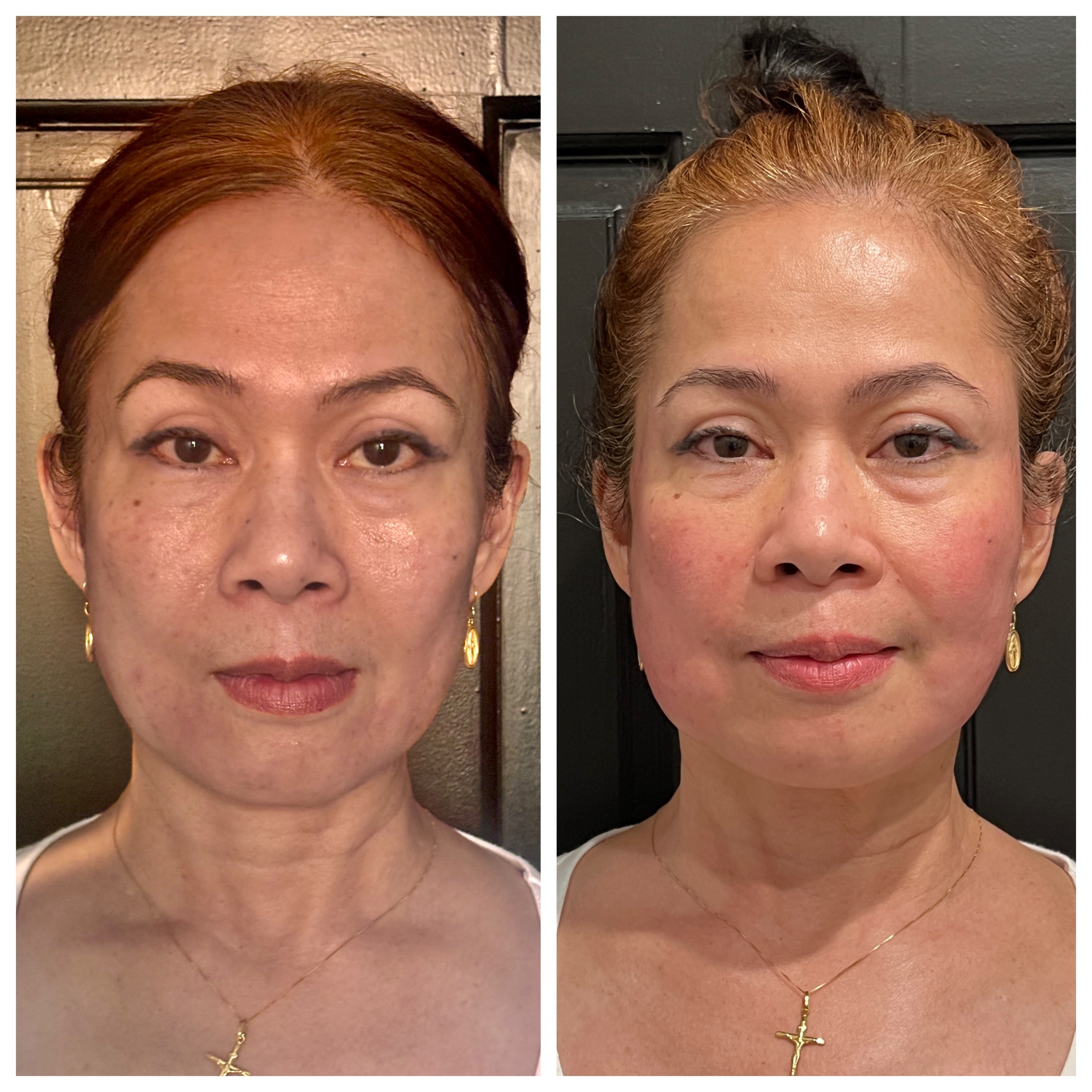 Sculptra before and after, GlowHaus Skin & Wellness, Allen TX