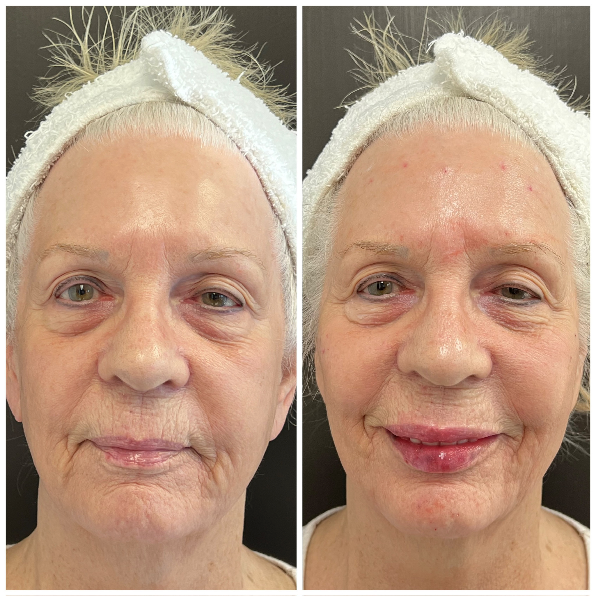 Fillers & Facial Balancing before and after, GlowHaus Skin & Wellness, Allen TX