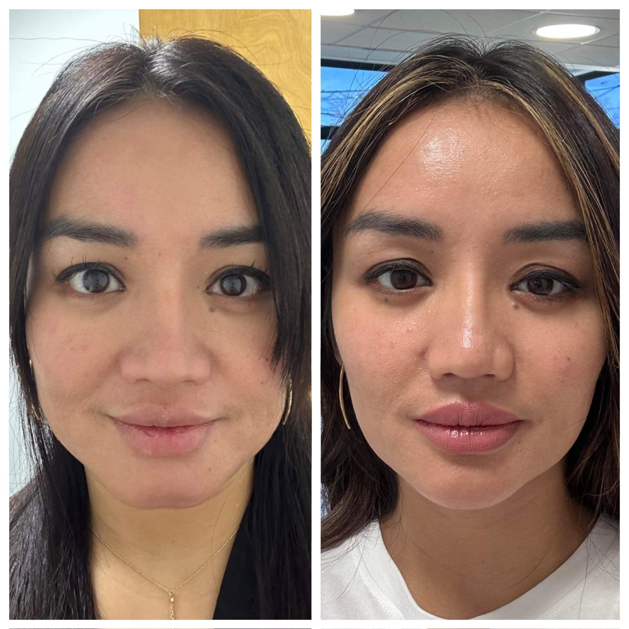Fillers & Facial Balancing before and after, GlowHaus Skin & Wellness, Allen TX