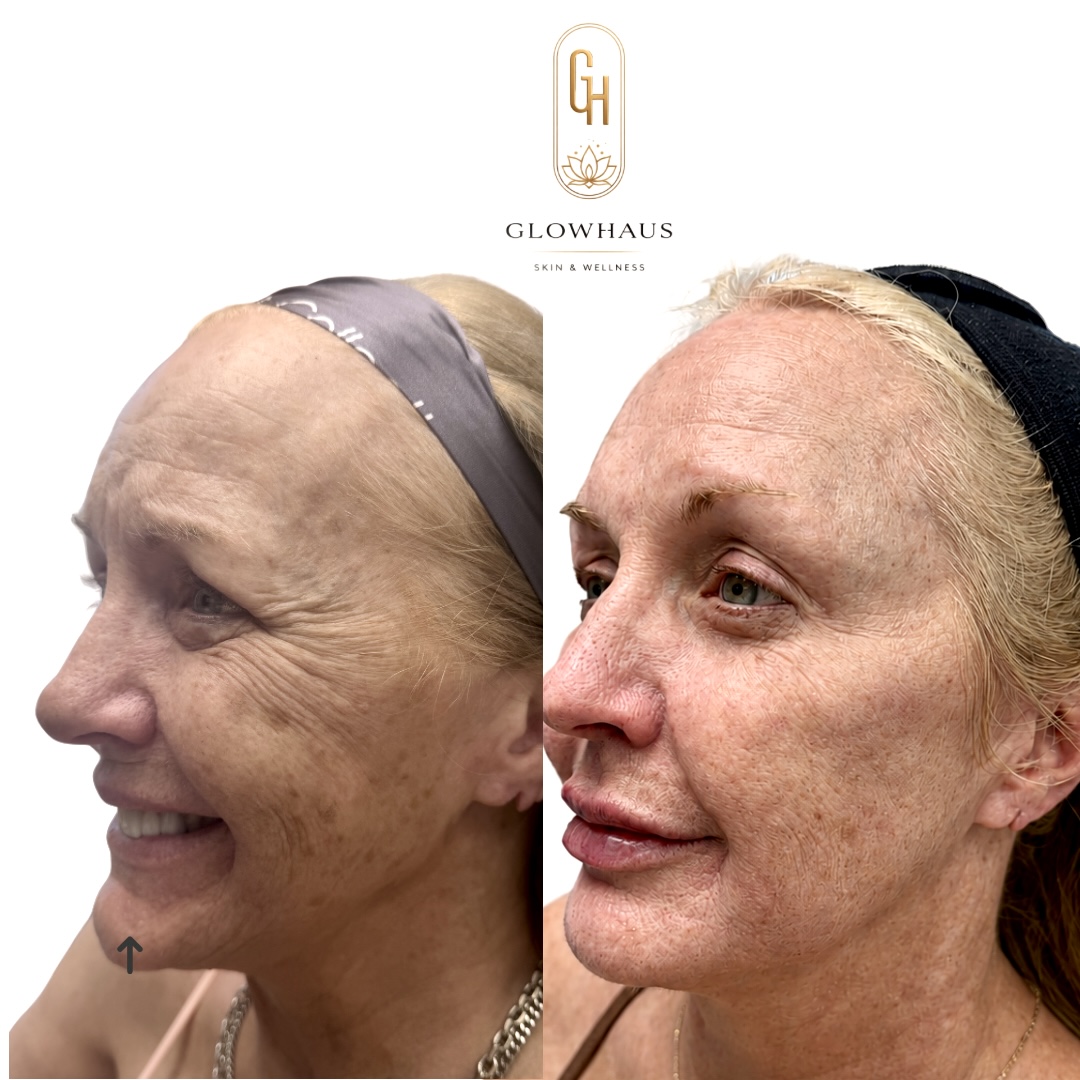 Sculptra before and after, GlowHaus Skin & Wellness, Allen TX