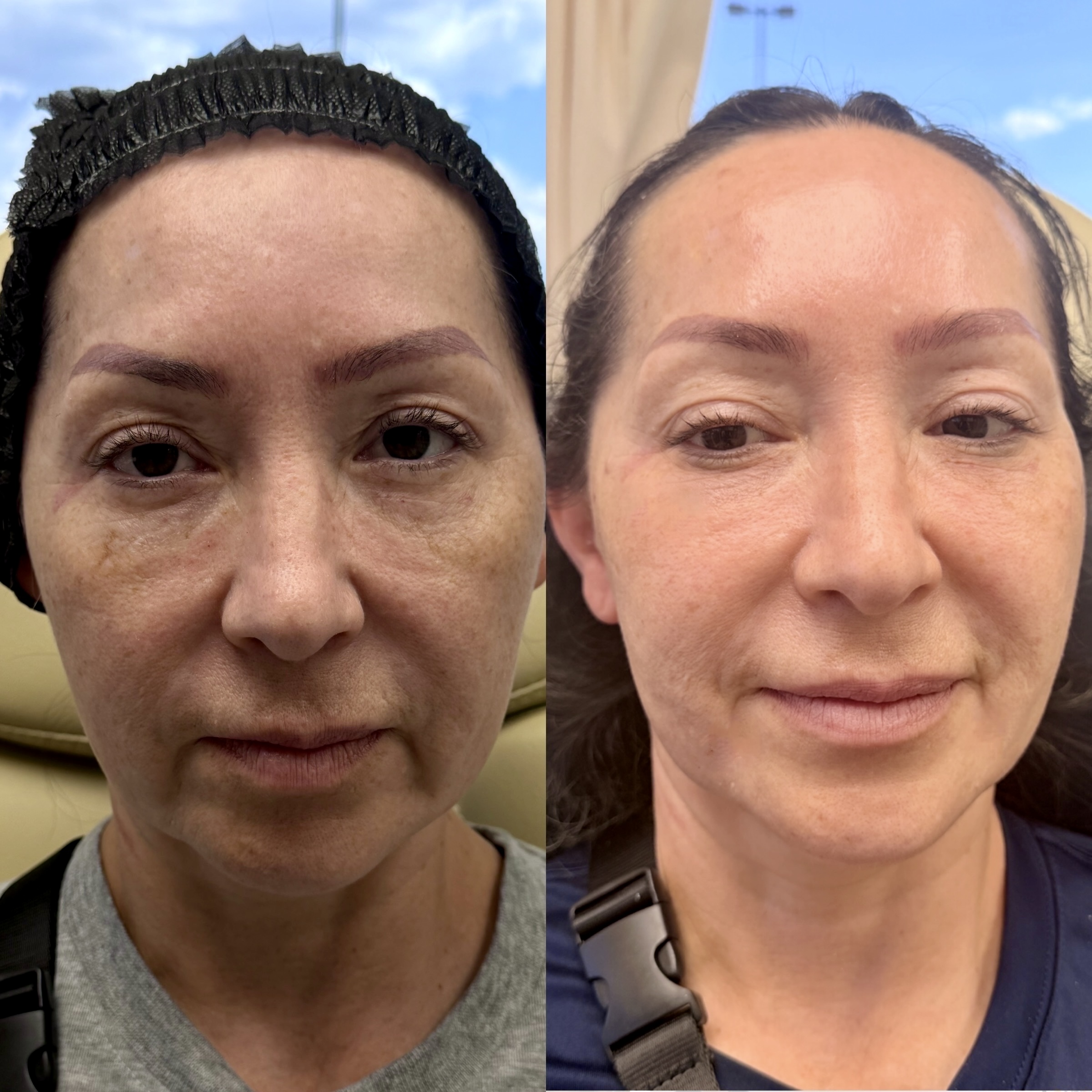 Sculptra before and after, GlowHaus Skin & Wellness, Allen TX
