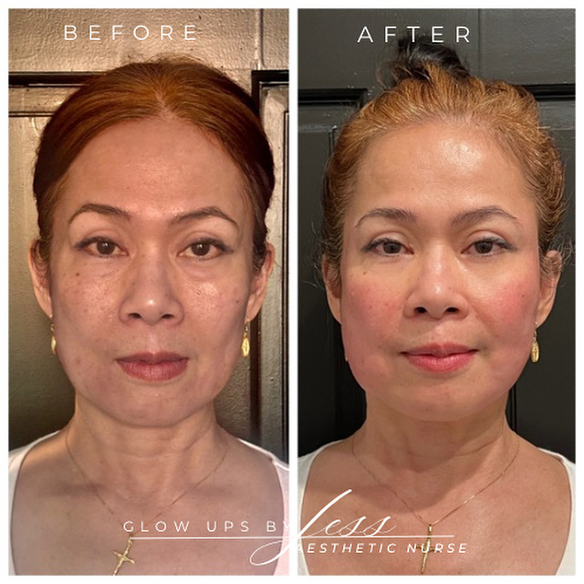 Sculptra before and after, GlowHaus Skin & Wellness, Allen TX