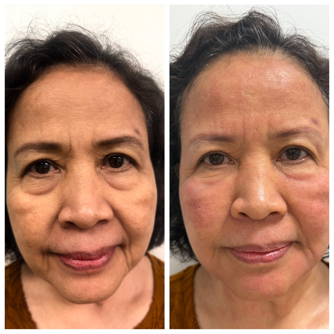 Fillers & Facial Balancing before and after, GlowHaus Skin & Wellness, Allen TX