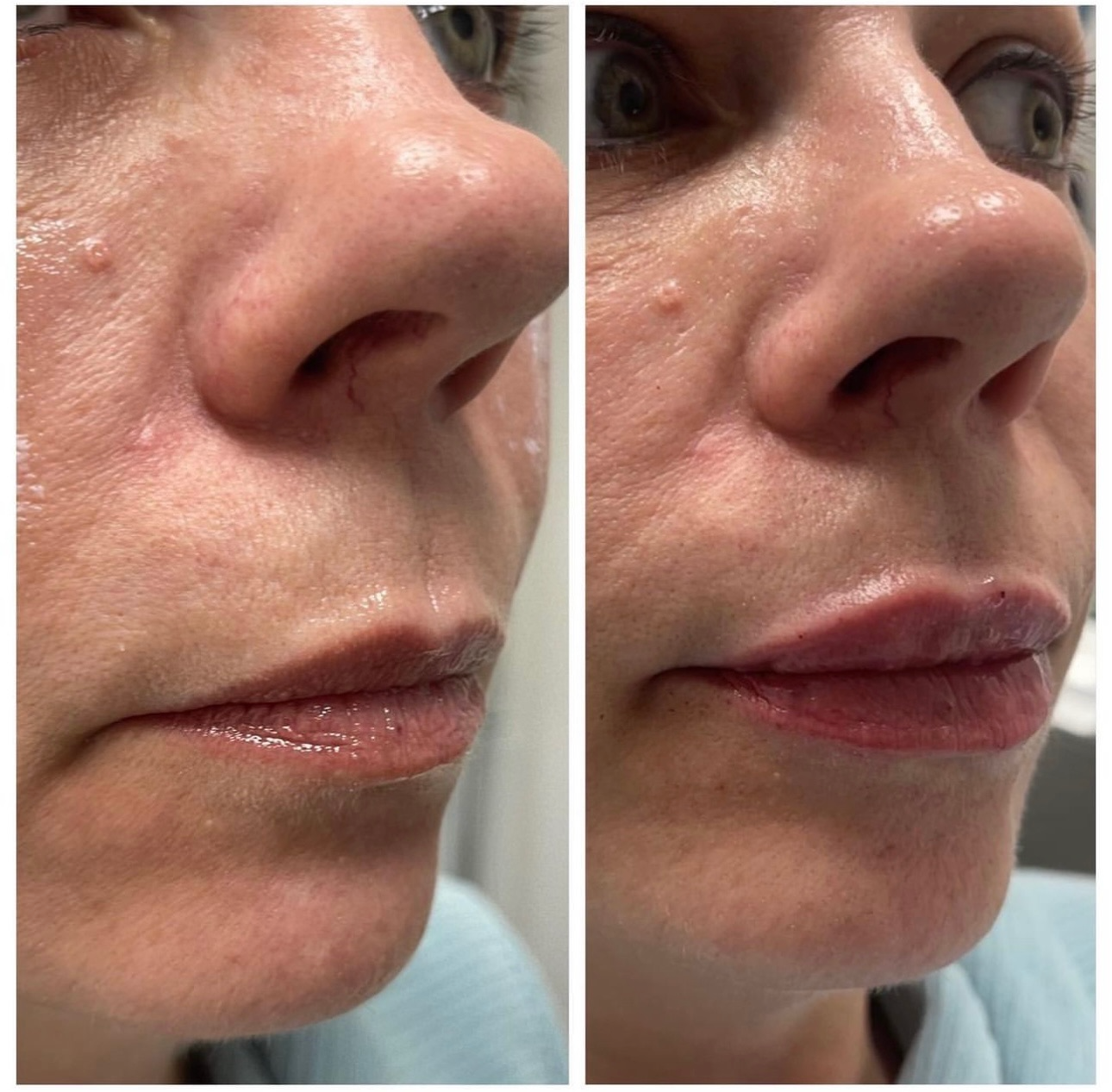 Fillers & Facial Balancing before and after, GlowHaus Skin & Wellness, Allen TX