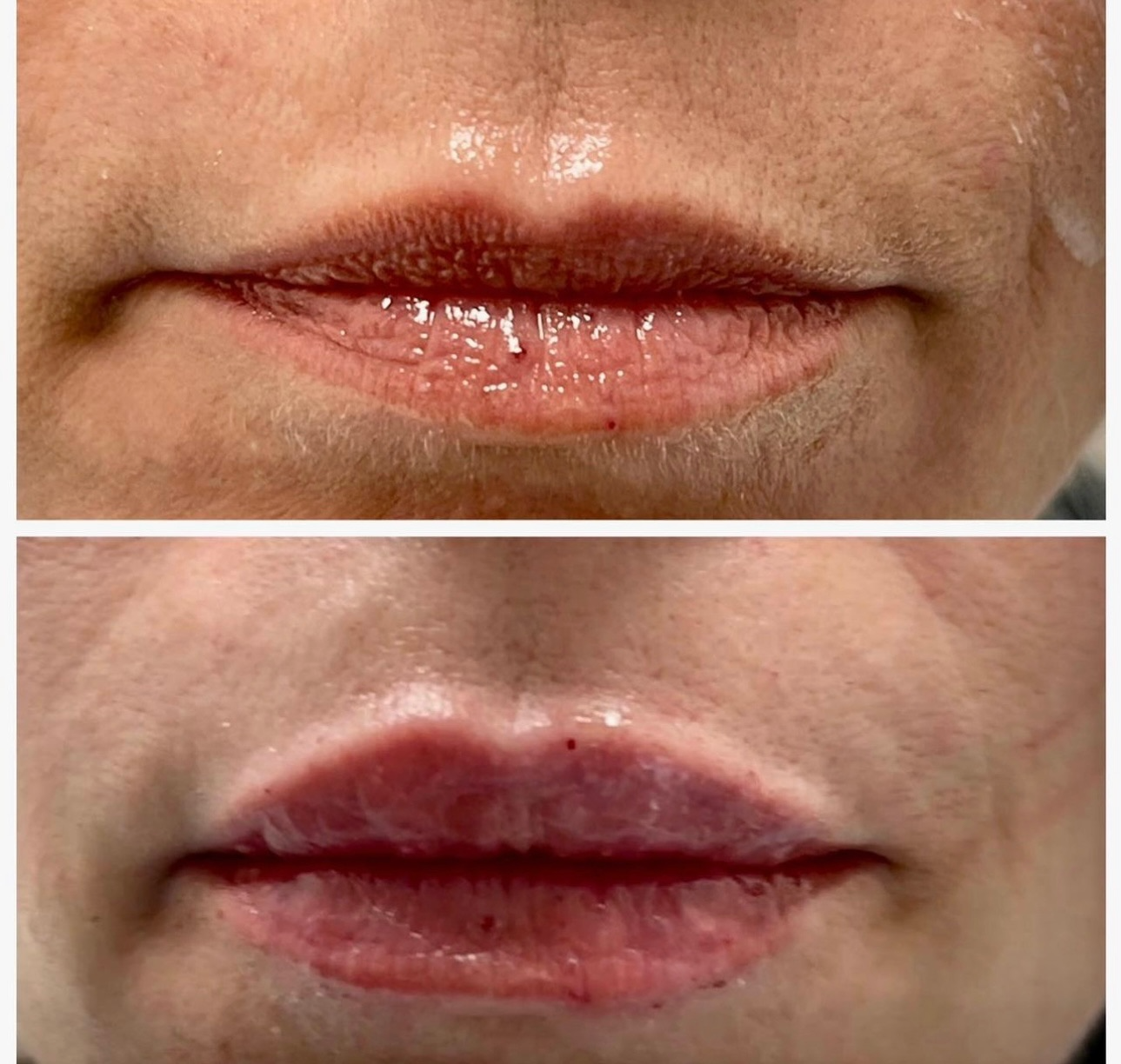 Fillers & Facial Balancing before and after, GlowHaus Skin & Wellness, Allen TX
