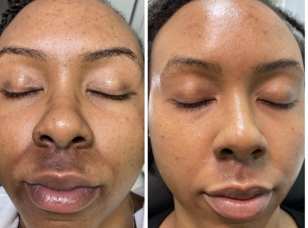 Facials & Peels before and after, GlowHaus Skin & Wellness, Allen TX