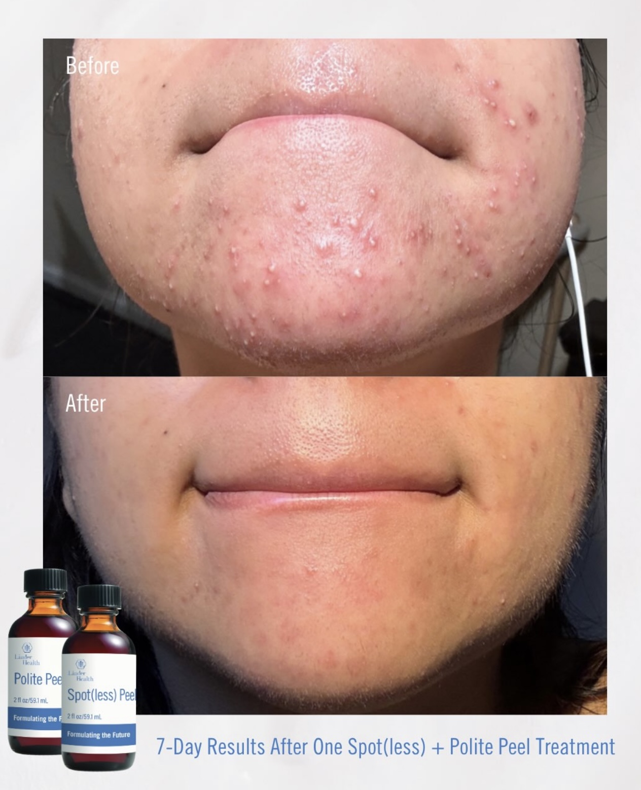 Facials & Peels before and after, GlowHaus Skin & Wellness, Allen TX
