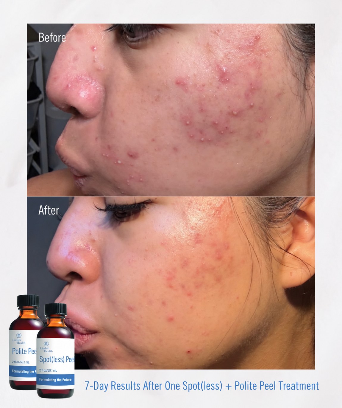Facials & Peels before and after, GlowHaus Skin & Wellness, Allen TX