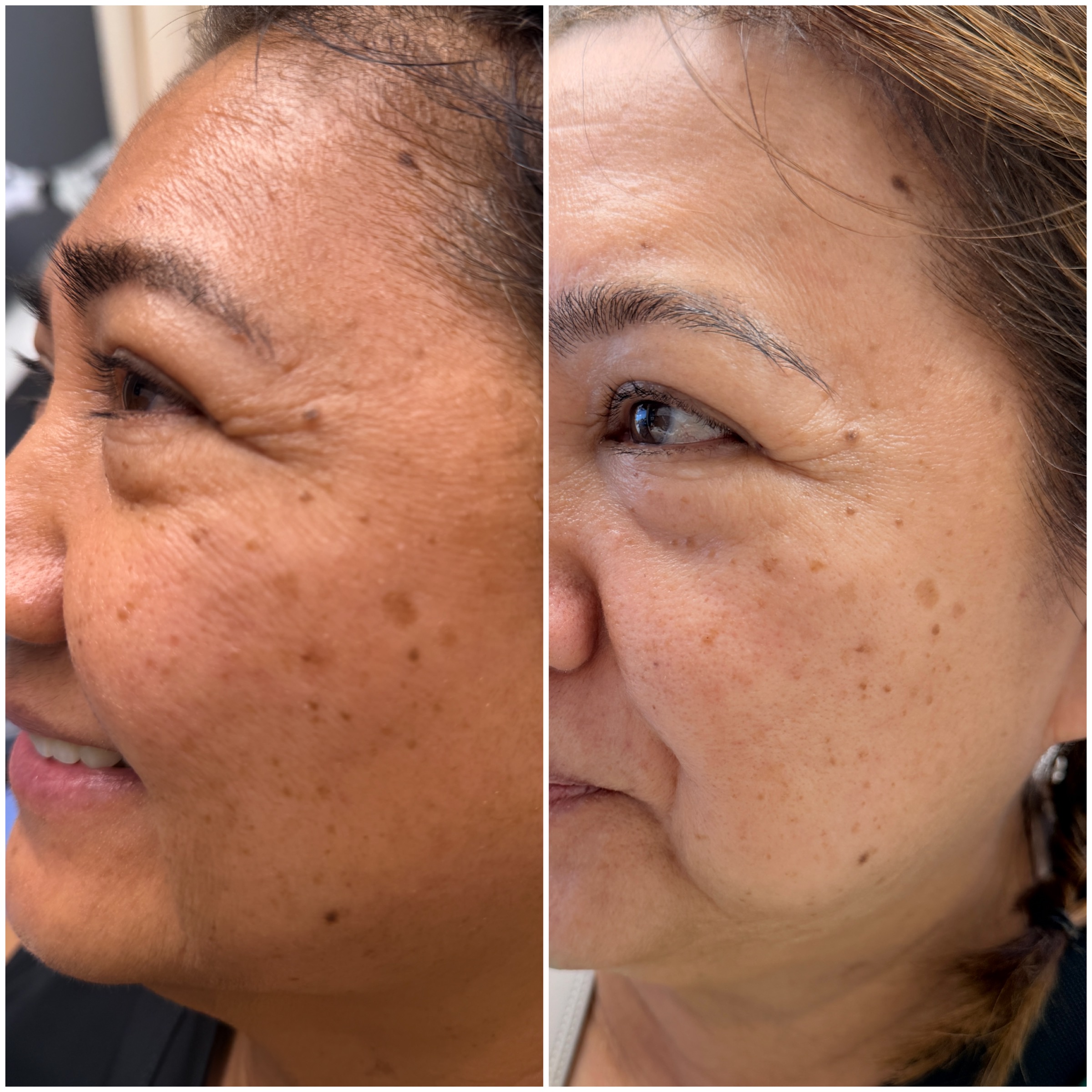 Facials & Peels before and after, GlowHaus Skin & Wellness, Allen TX